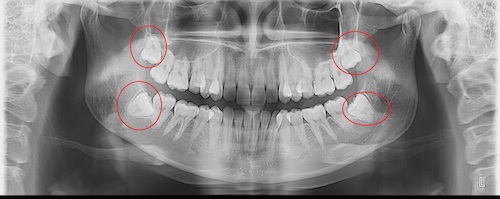 Осложнения после ортодонтии